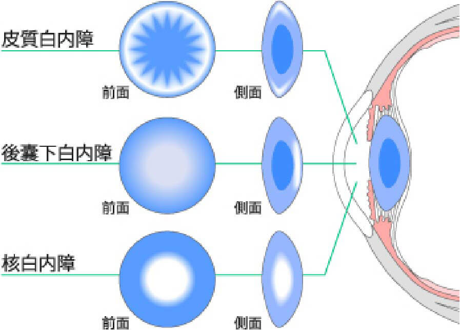 水晶体の硬化