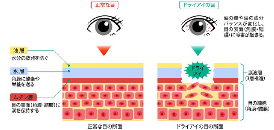 ドライアイ