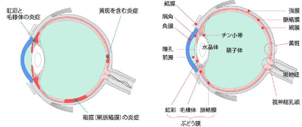 ぶどう膜炎